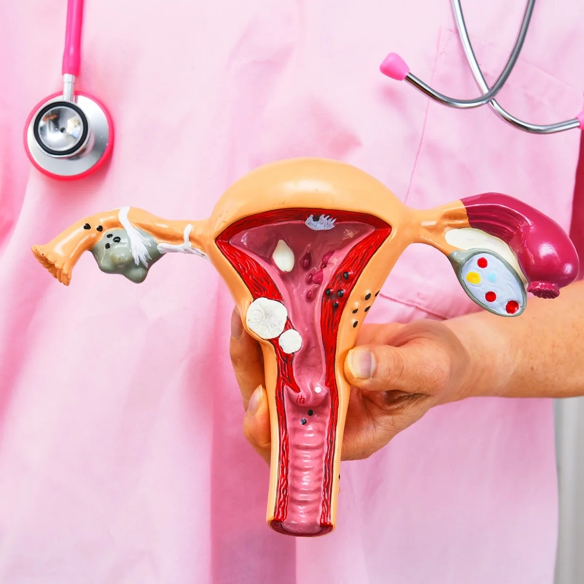 Planos de saúde passam a cobrir DIU hormonal para pessoas com endometriose