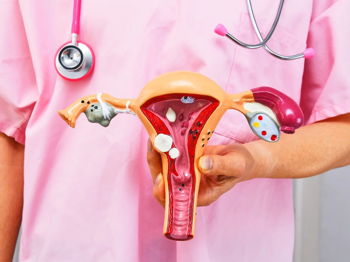 Planos de saúde passam a cobrir DIU hormonal para pessoas com endometriose